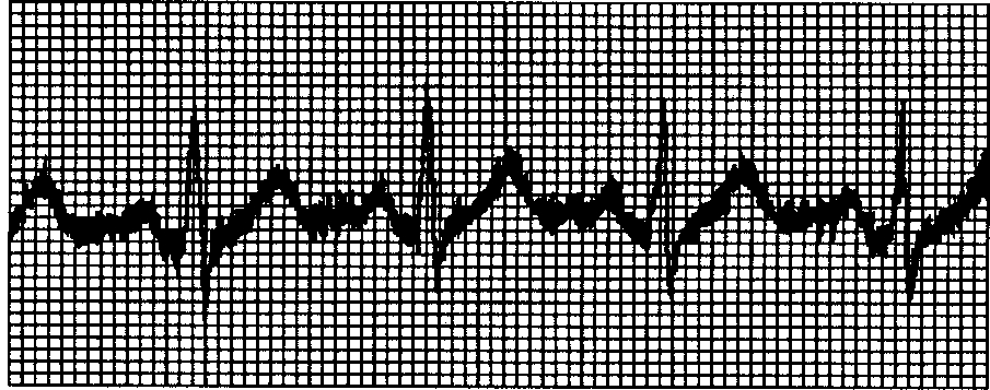 4.2 有肌电干扰⑥ 附近是否有功率较大电气设备在工作?